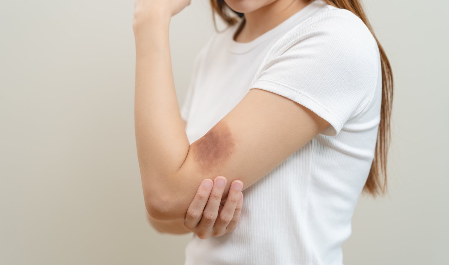 Woman's bruised arm against a plain background following a violation of C.R.S. 18-3-204